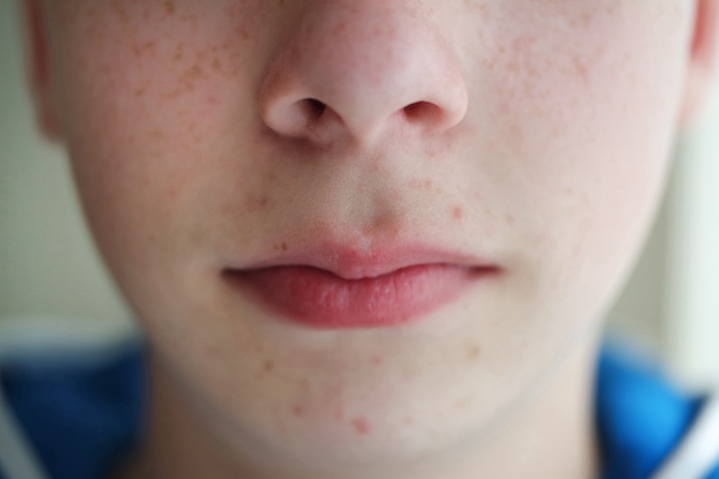 Acne: Symptoms and Treatment